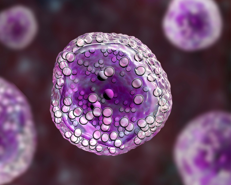 Dati su polatuzumab vedotin con BR per il linfoma DLBCL R/R